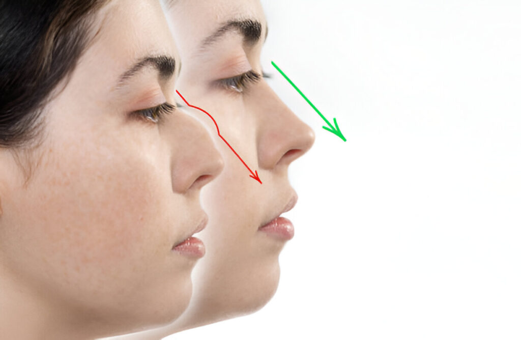 Before and after profile view illustrating rhinoplasty results related to how much does a nose job cost.